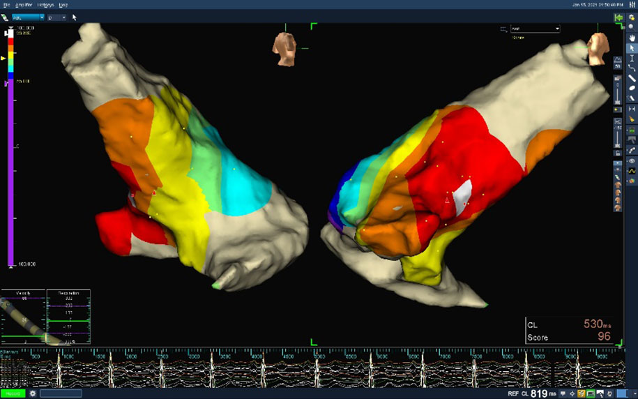 The heart is simulated via 3D mapping to ensure accurate location of the ventricular external systole