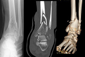 Gãy Pilon được hiển thị dưới hình ảnh của X-quang, CT Scan và tái tạo hình ảnh ba chiều