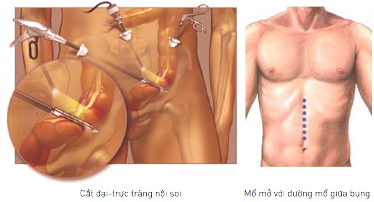 Có-2-loại-phẫu-thuật-cắt-đại-trực-tràng