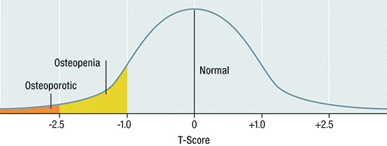 Tiêu chuẩn chẩn đoán loãng xương của WHO
