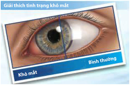 Tình-trạng-khô-mắt-và-bình-thường