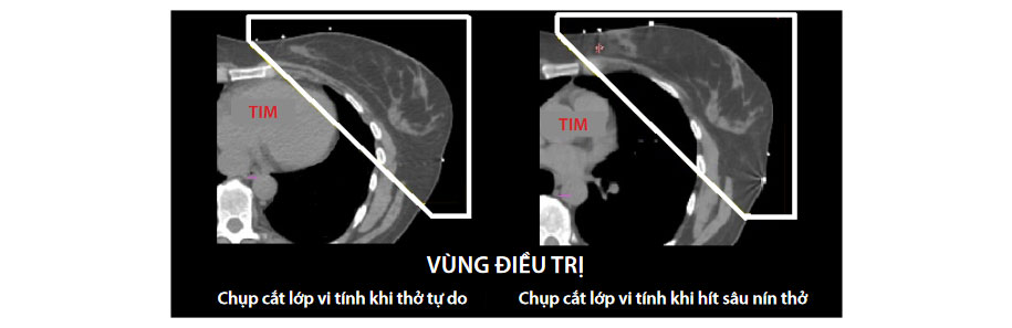 Mô-tả-hít-sâu-nín-thở-kỹ-thuật-xạ-trị-đặc-biệt