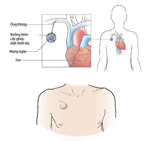 Mô-tả-buồng-tiêm