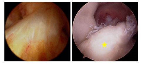 (Trái) Hình ảnh nội soi khớp của DCCT bình thường. (Phải) Hình ảnh nội soi khớp của DCCT bị đứt [vị trí sao vàng].