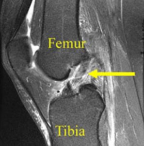 Hình ảnh MRI cho thấy dây chằng chéo trước đứt hoàn toàn