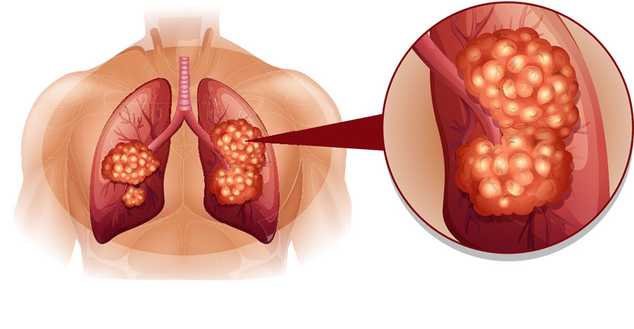 Hình-ảnh-minh-họa-ung-thư-phổi