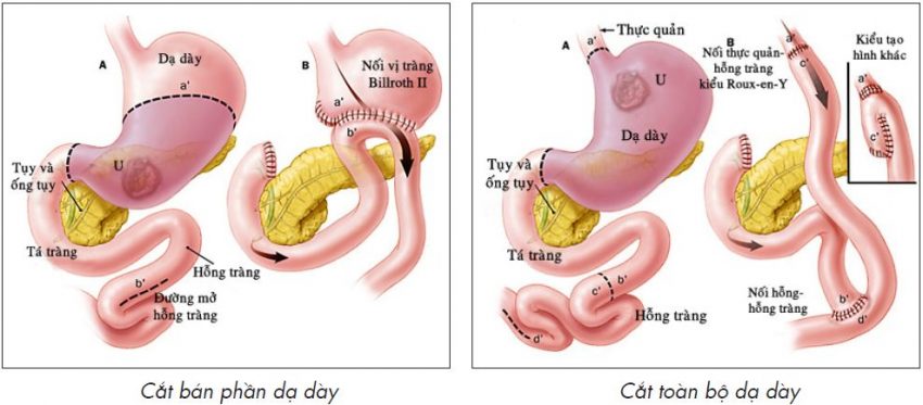 Các-hình-thức-phẫu-thuật-cắt-dạ-dày 