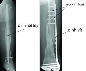 (Trái) Hình ảnh X-quang cho thấy chỗ gãy thân xương đùi chữa lành được điều trị bằng đóng đinh nội tủy. (Phải) Gãy xương đùi đã được điều trị bằng nẹp kim loại và đinh vít.