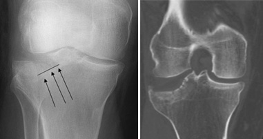 Bác sĩ thường sử dụng hình ảnh X-quang (bên trái) và CT (bên phải) để xác định vị trí và độ di lệch của từng mảnh xương gãy.