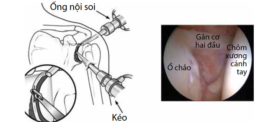 (Trái) Trong quá trình nội soi, bác sĩ phẫu thuật đưa ống nội soi và những dụng cụ phẫu thuật rất nhỏ vào khớp vai của bệnh nhân. (Phải) Hình ảnh nội soi bên trong khớp vai.