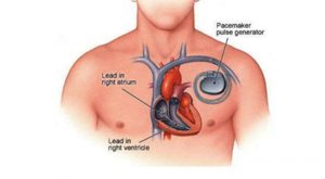 Runawau Pacemaker Pacemakers - FV Magazine