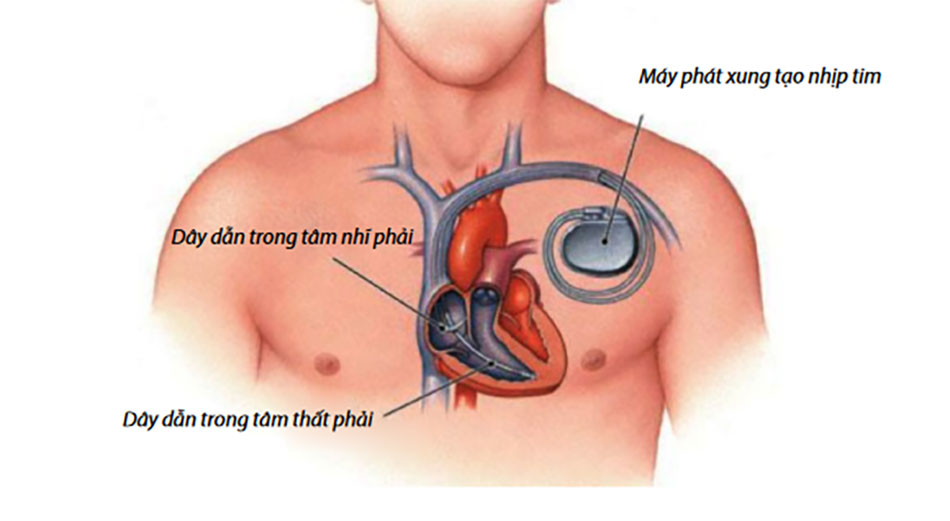 sơ đồ đặt máy tạo nhịp tim