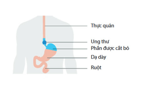 Mô-phỏng-ung-thư-thực-quản