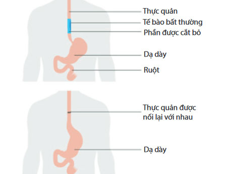 Thực-quản-sau-khi-cắt-bỏ-phần-ung-thư-và-nối-lại