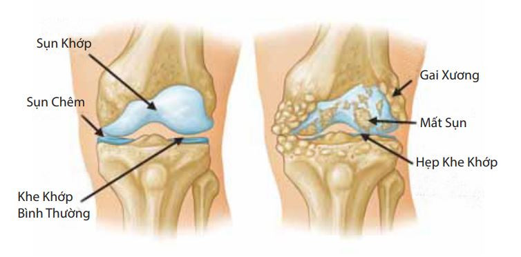 Viêm xương khớp thường gây ra tình trạng trạng cọ sát xương. Gai xương là đặc điểm phổ biến của dạng viêm khớp này. 