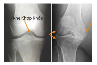 (Trái) Hình ảnh X-quang của khớp gối bình thường, khe giữa các xương cho thấy sụn khỏe mạnh (mũi tên). (Phải) Hình ảnh X-quang của khớp gối bị viêm cho thấy mất khe khớp và gai xương nặng (mũi tên).