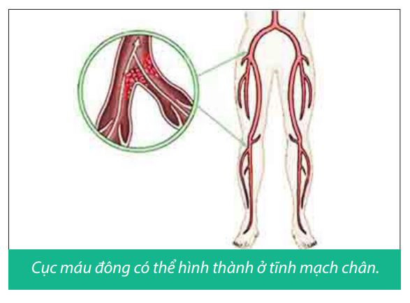 Xuất hiện máu đông trong mổ thay khớp háng