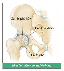 Khớp háng bị viêm