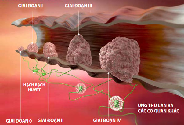 Các-giai-đoạn-ung-thư-đại-trực-tràng 