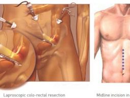 Phẫu-thuật-cắt-đại-trực-tràng