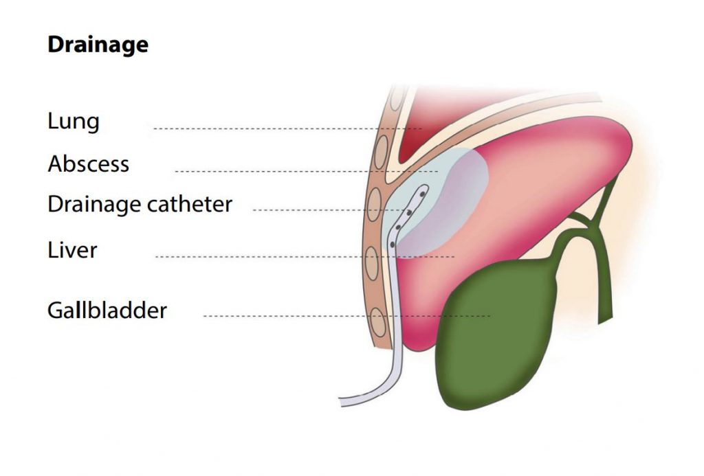 Percutaneous Abscess Drainage - FV Magazine
