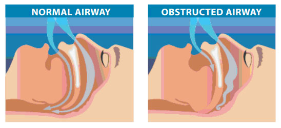 Obstructive Sleep Apnoea Fv Magazine 