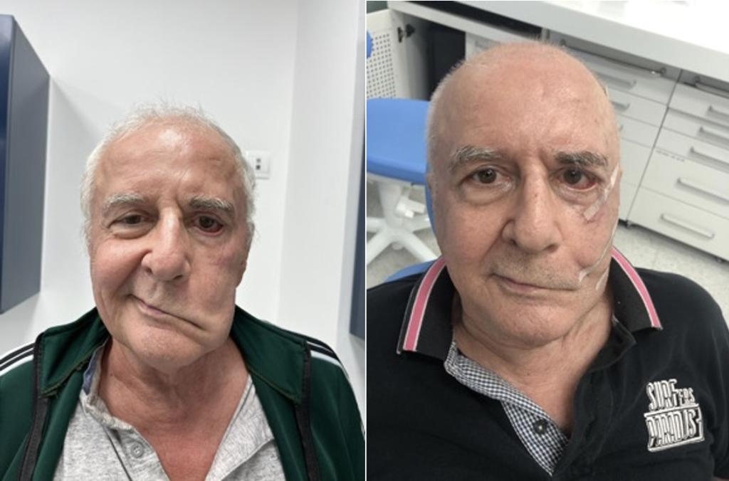 Mr Engelmann before and after surgery.