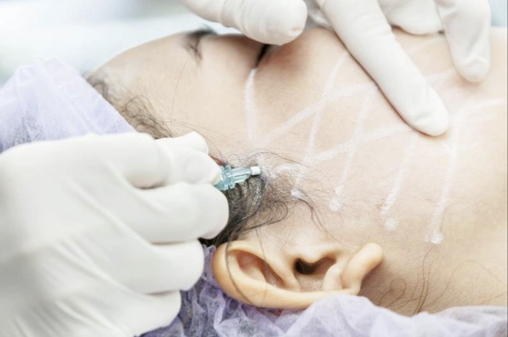 Thread lifting is a minimally invasive method for skin rejuvenation.