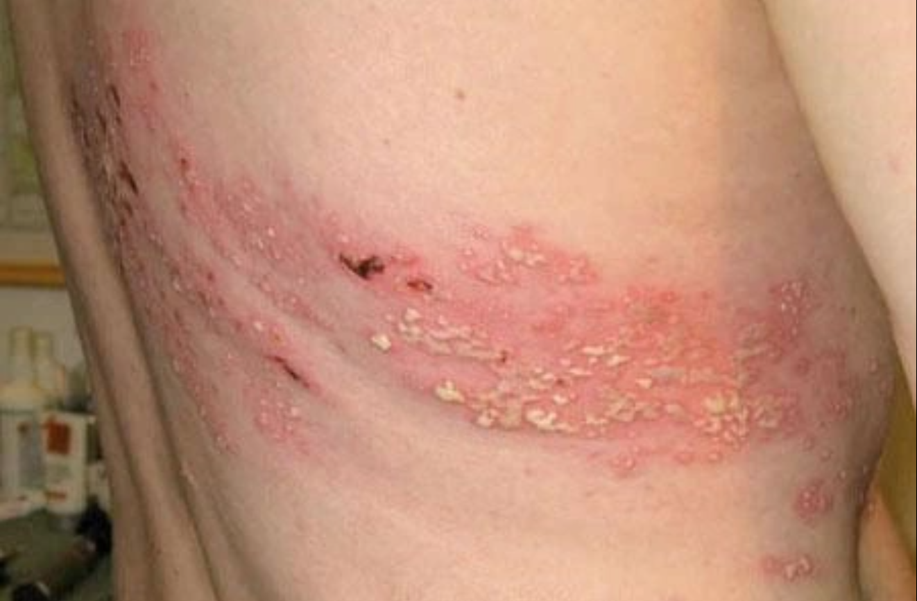 A shingles rash, caused by the herpes zoster virus