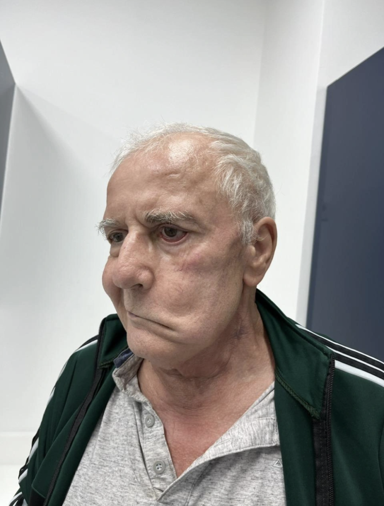 Patient Gilbert Engelmann's face before surgery.