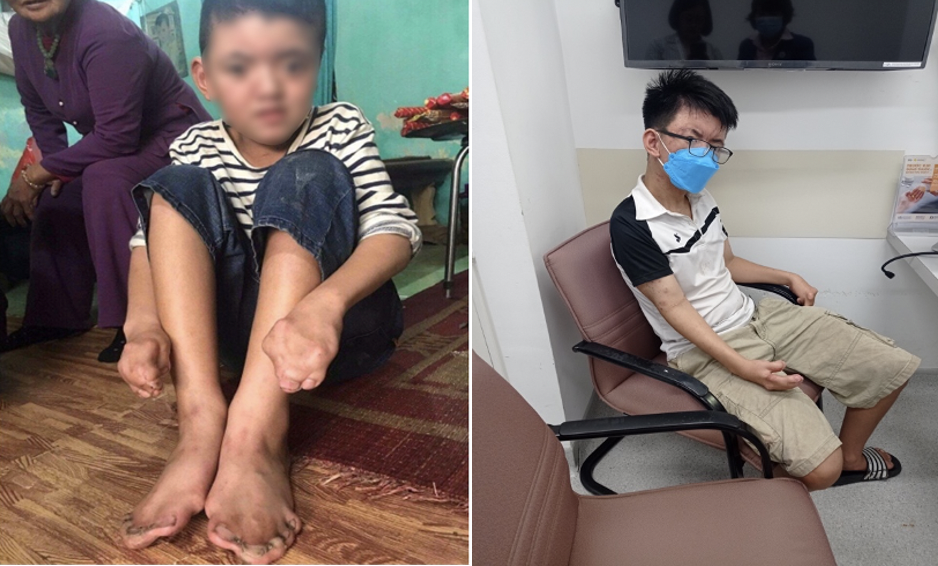 Trung’s hand before and after his third surgery