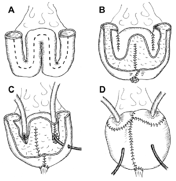 Hình minh họa kỹ thuật tạo hình bàng quang mới: Ruột được cắt ra (A), khâu thành túi (B), nối với hai ống từ thận xuống (C) và nối với 2 ống dẫn nước tiểu (D)