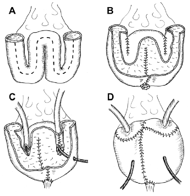 Illustration of the technique for creating a new bladder: The intestine is cut (A), sewn into a pouch (B), connected to two tubes from the kidneys (C), and linked to two ureteral tubes (D).