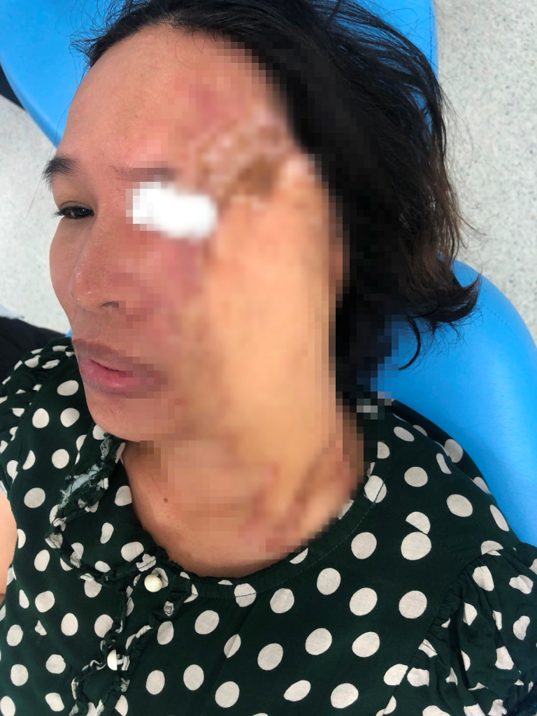 Sau tai nạn, chị Thuỷ phải trải qua hơn 20 lần phẫu thuật điều trị và tạo hình vùng mặt, hiện vùng mặt bên trái bị co rút, dính khớp thái dương hàm hai bên nên không thể há miệng được 