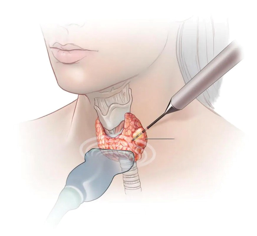 "The RFA technique delivers high-frequency waves into the thyroid nodule to destroy the thyroid tissue through a small needle," Dr Luong Ngoc Trung explained.