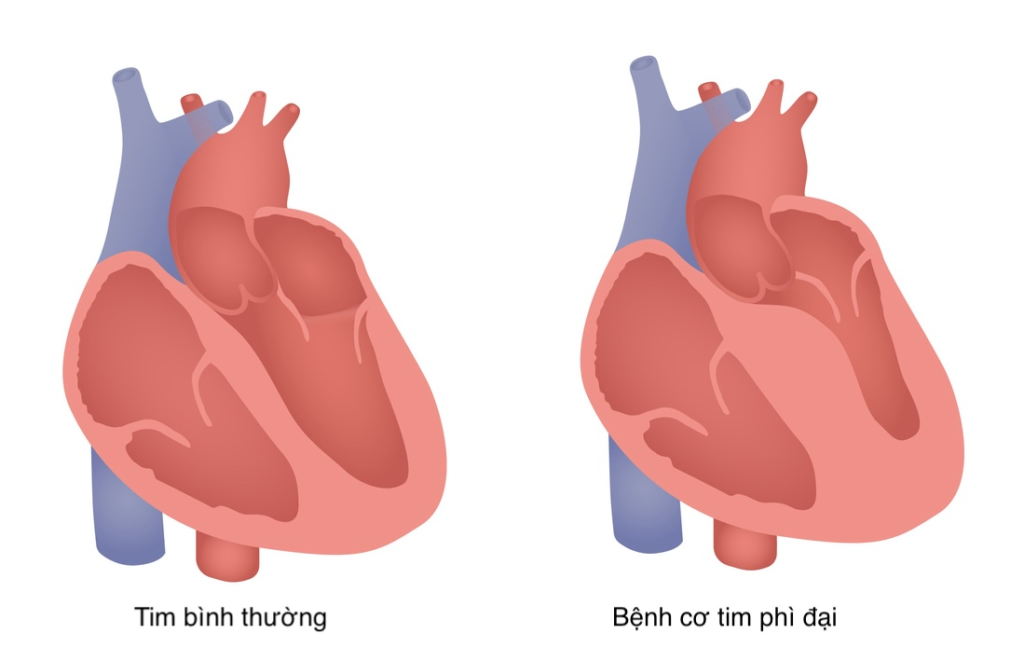 Illustration of a normal heart (left) and a heart affected by hypertrophic cardiomyopathy (right) with thickened heart walls.