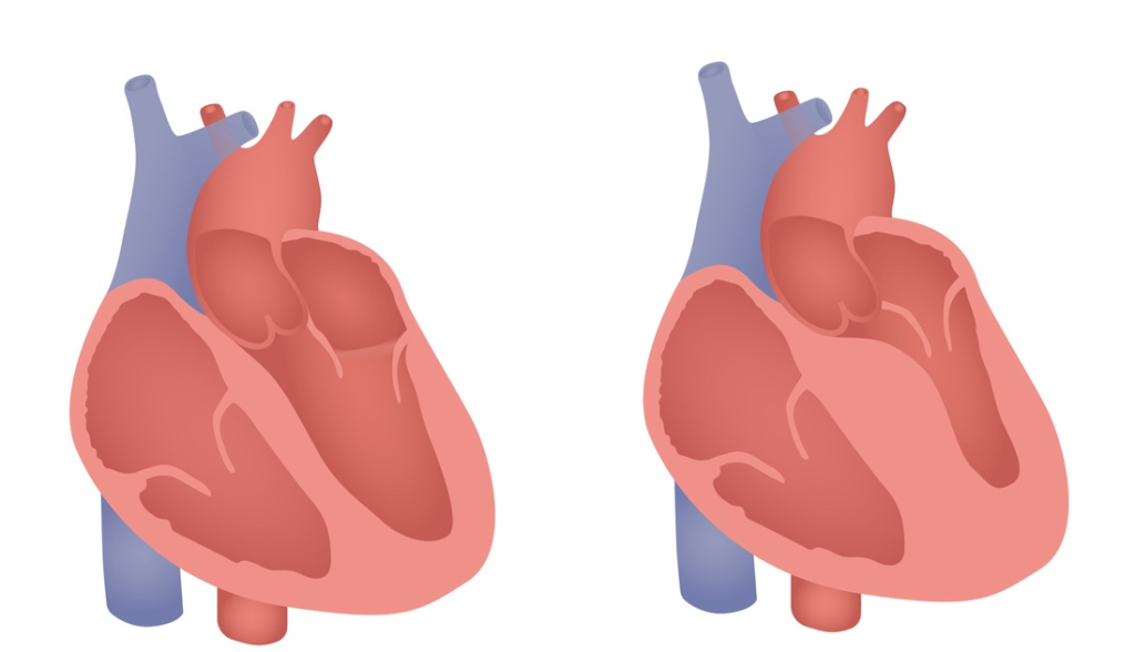 Illustration of a normal heart (left) and a heart affected by hypertrophic cardiomyopathy (right) with thickened heart walls.