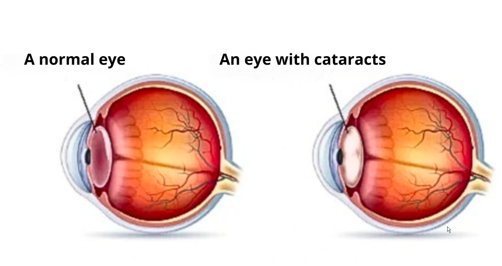 Simulation of a normal eye and an eye with cataracts