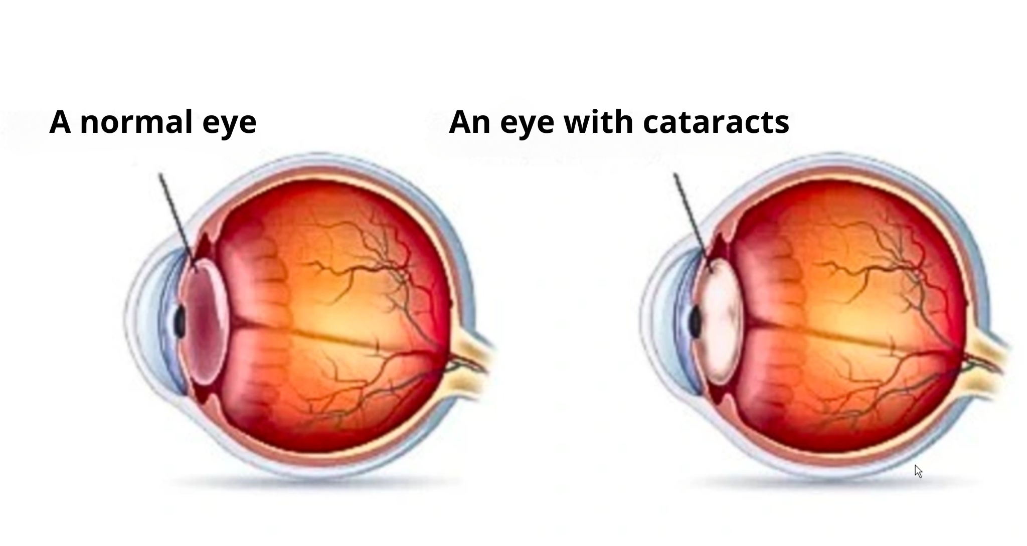 A 5-YEAR-OLD BOY'S VISION REDUCED TO 1/10 DUE TO AN EYE CONDITION ...