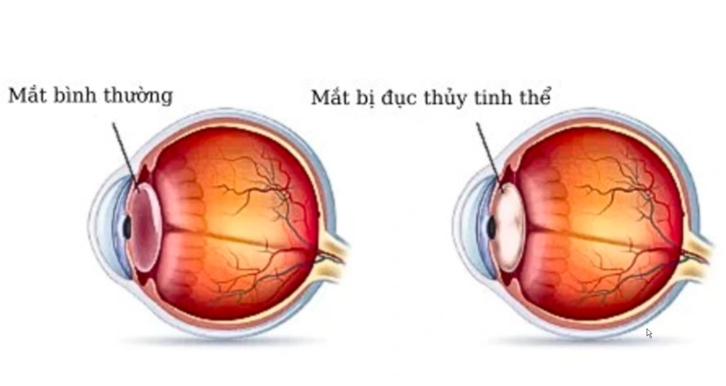 Mô phỏng mắt bình thường và mắt bị đục thủy tinh thể