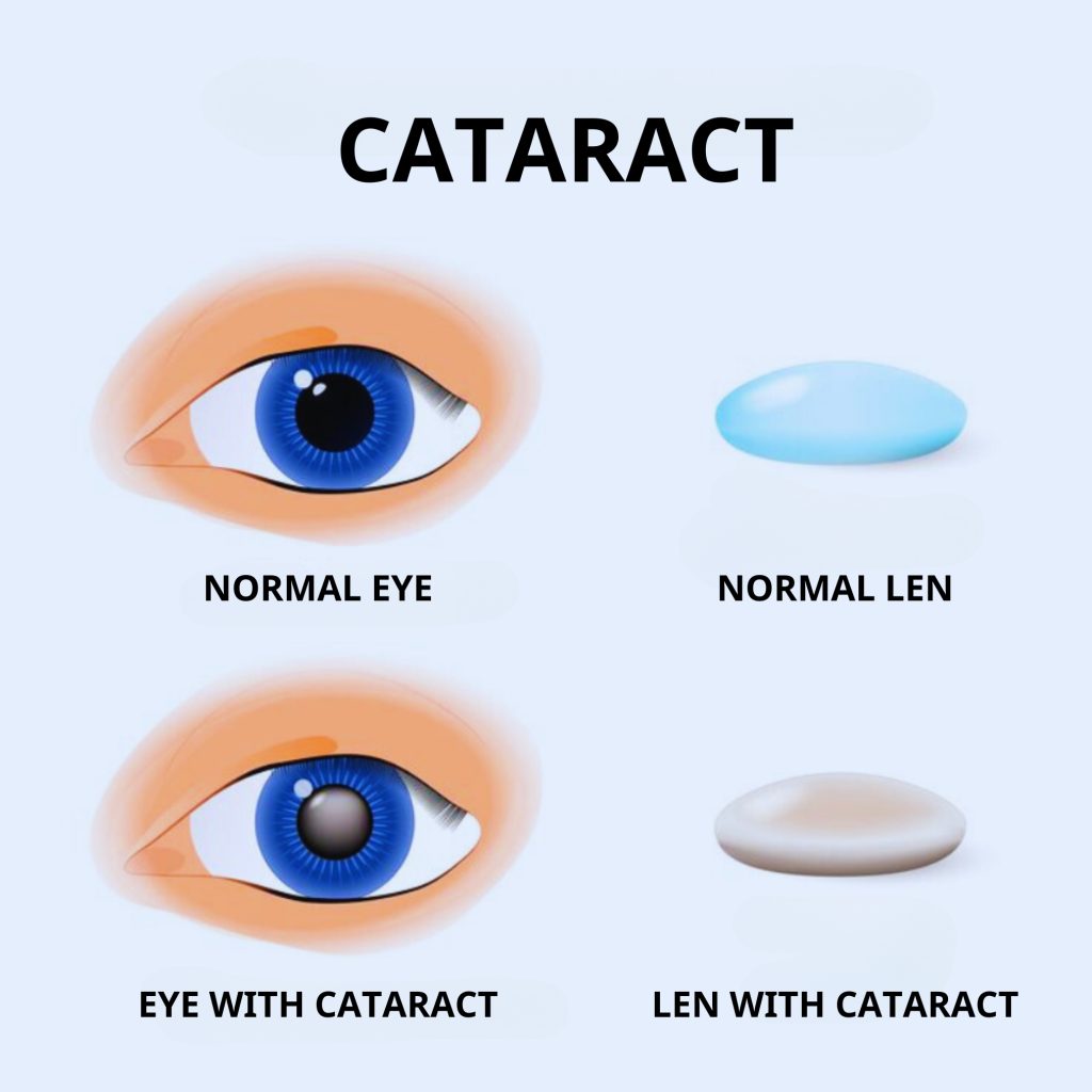 Simulation of cataract condition