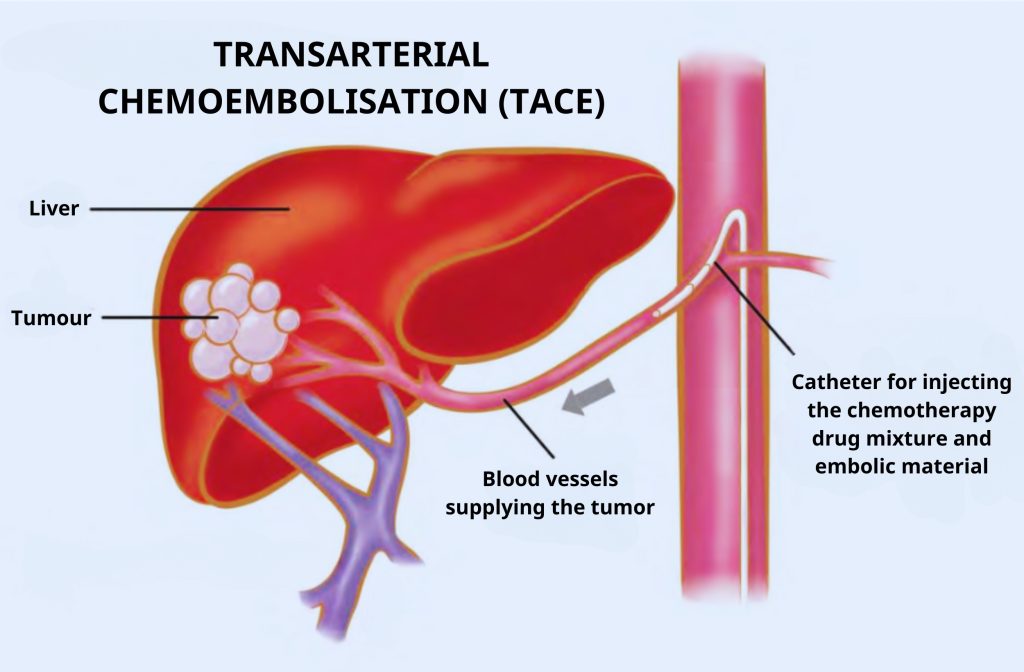 Illustration of the Transarterial Chemoembolization (TACE) liver procedure.