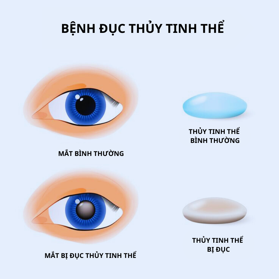 Mô phỏng bệnh đục thủy tinh thể