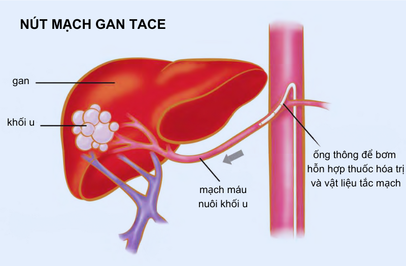 Hình minh họa thủ thuật bơm hóa chất tắc nút mạch gan TACE