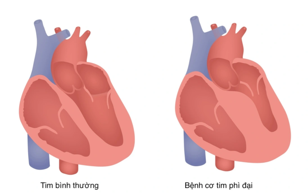 Hình minh họa trái tim bình thường (trái) và trái tim bị bệnh cơ tim phì đại (phải) với thành tim dày lên