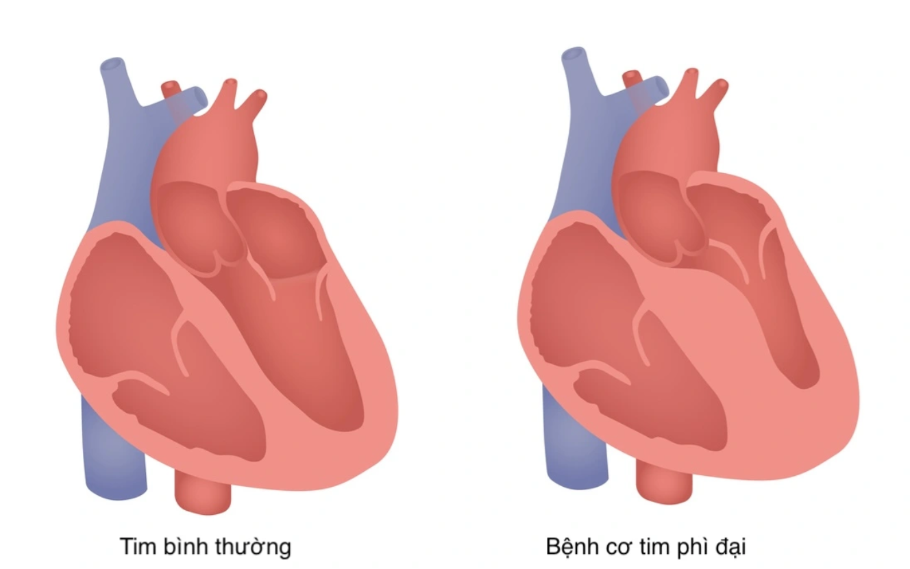 BƠM CỒN SINH HỌC CỨU SỐNG BỆNH NHÂN BỊ BỆNH CƠ TIM PHÌ ĐẠI NẶNG - FV ...