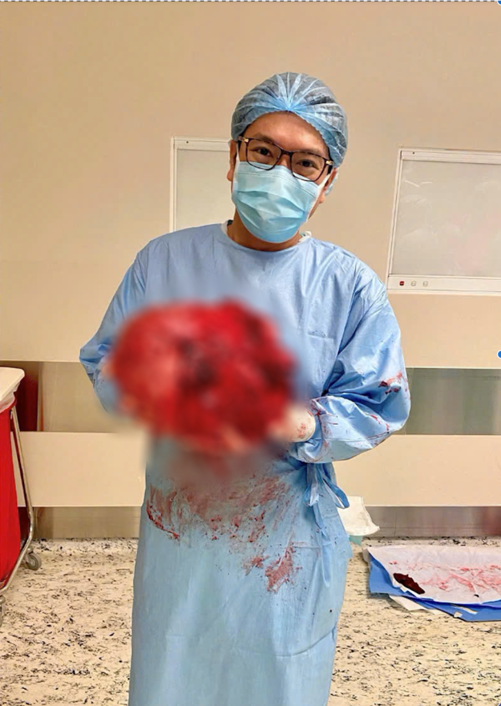 Dr Vo Trieu Dat felt a sense of relief after successfully removing the 8 kg uterine fibroid, ensuring the patient’s safety.