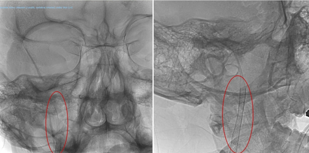 Hình ảnh mạch máu của bệnh nhân sau khi được đặt stent