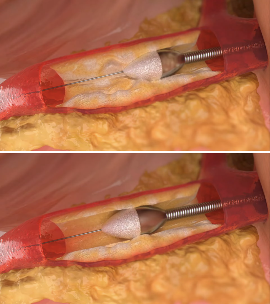 Illustration showing the operation of the ROTAPRO machine with a diamond drill bit breaking down calcified plaque causing artery blockage