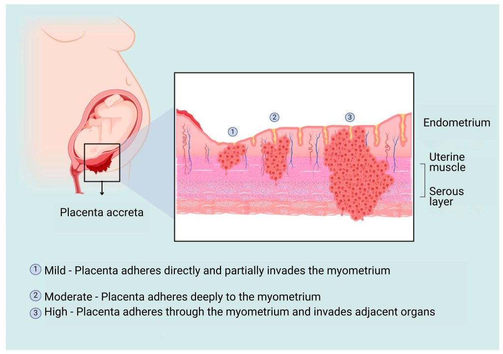 Placenta accreta can lead to complications such as postpartum haemorrhage.